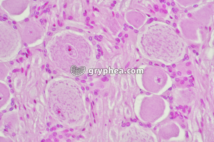 Ganglion rachidien CT x100 - gryphea.org